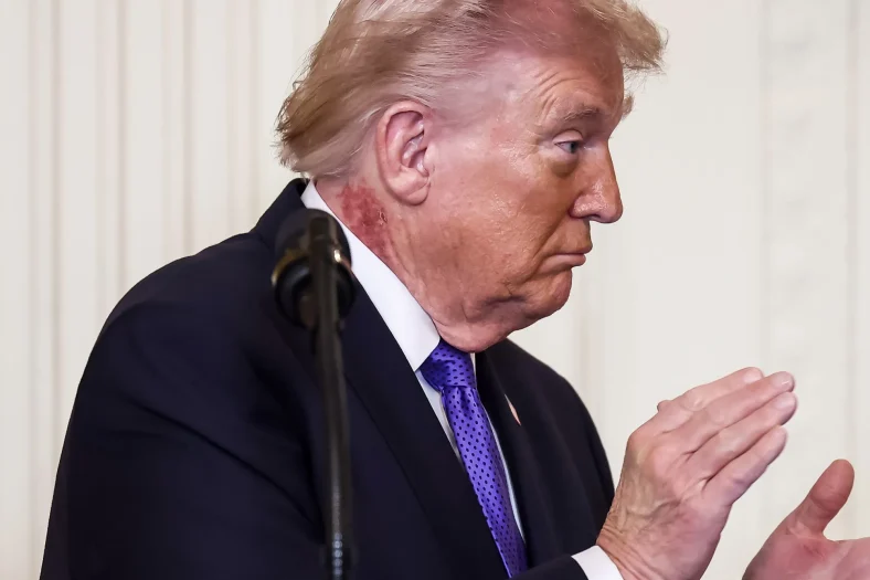 Трамп проходить медогляд через набряки, синці та хворобу вен
